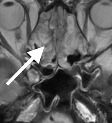 副鼻腔炎による頭痛