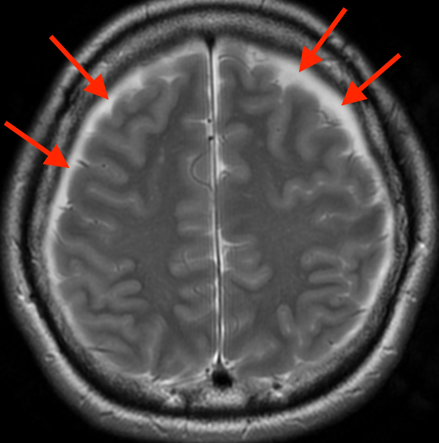 脳脊髄液減少症の軸位断MRI