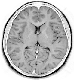 MRI正常例