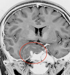 MRI脳腫瘍例
