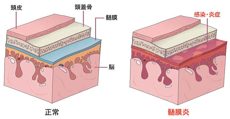 風邪で頭痛だけ治らない